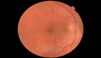 Image of Retina (back of the eye)