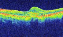 Age-related Macular Degeneration Wet Form