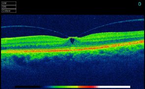 The vitreous (jelly) pulling on the retina