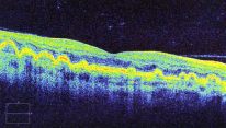 Age-related Macular Degeneration Dry Form