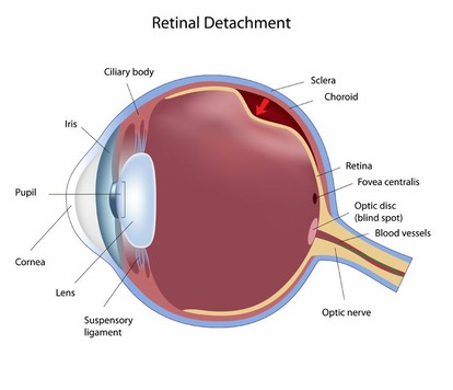 Sketch of Retinal Detachment in the eye