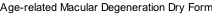 Age-related Macular Degeneration Dry Form