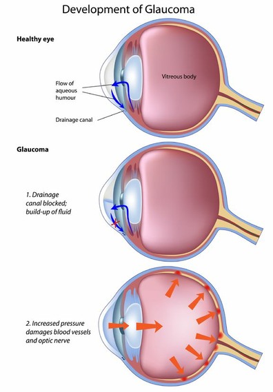 Sketch of glaucoma