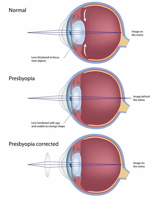 Sketch of Presbyopia