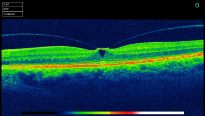 The vitreous (jelly) pulling on the retina