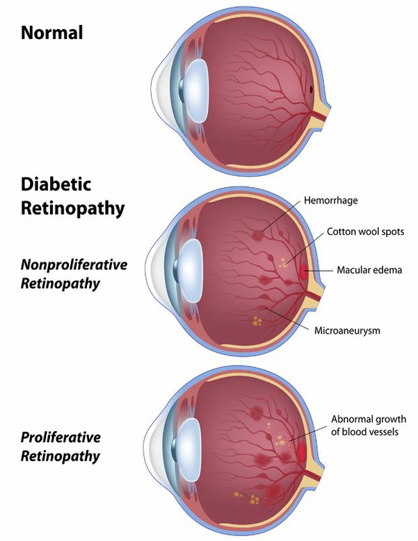 Sketch of Diabetic Eye Health