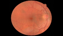 Image of Retina (back of the eye)