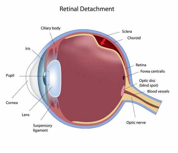 Sketch of Retinal Detachment