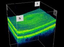 A 3D section of the layers ofthe retina and vitreous jelly