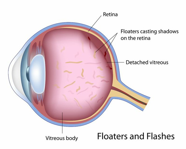 Sketch of Flases and Floaters in the eye