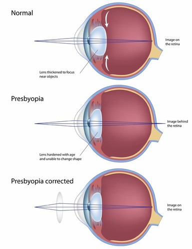 Sketch of Presbyopia