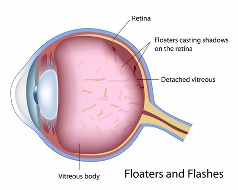 Sketch of flashes and floaters in the eye